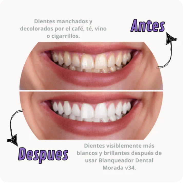 Blanqueador Dental Morada V34